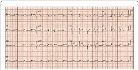 lv segmental hypokinesia|mild ventricular hypokinesis.